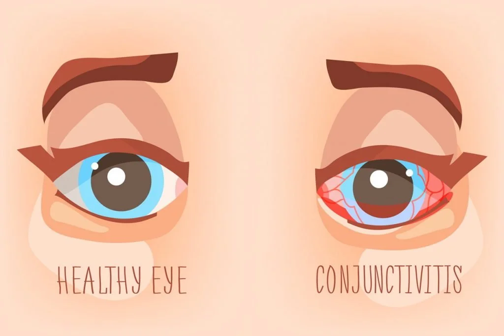 illustration showing a healthy eye and an eye with conjunctivitis 