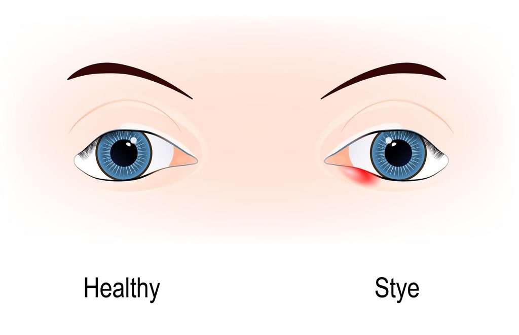 Eyes Of Human Stye External Hordeolum Of Lower Eyelid Vector Id899654164 E1567610903594 