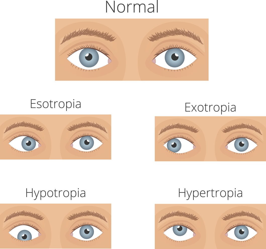 Five types of strabismus: esotropia, exotropia, hyertropia, hypotropia