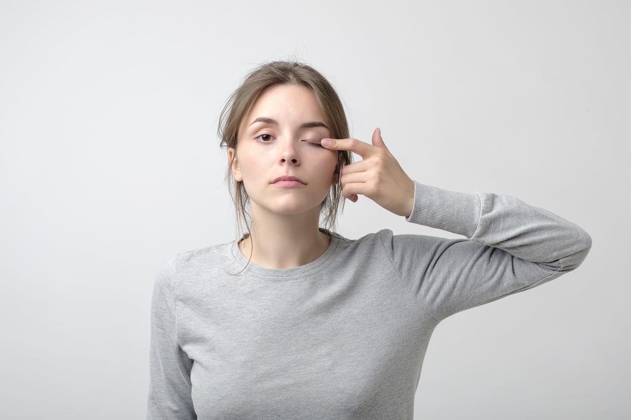 woman closing one eye, showing possible lazy eye symptoms