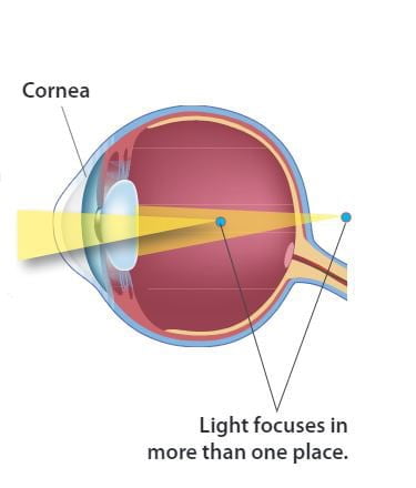 astigmatism eye diagram