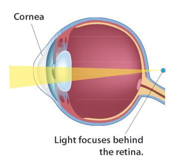 hyperopia eye diagram