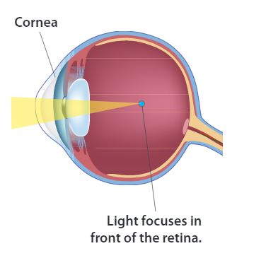 myopia eye diagram