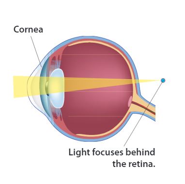 presbyopia eye diagram